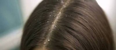 Dandruff